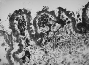 M, 63y. | cyst of choroid plexus - dystrophic calcification